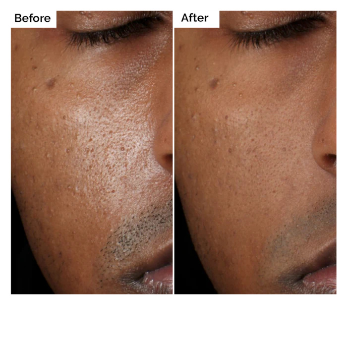 Aloe 2% + NAG 2% Solution Seru - Aha Bha Exfoliant recension och pris
